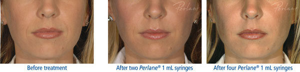 Restylane Lyft treatment photo