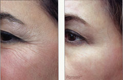 Plasma skin regeneration eyes before and after photo