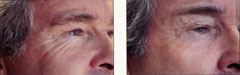 Plasma skin regeneration eyes side before and after photo