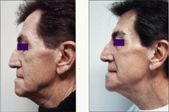 Plasma skin regeneration face side before and after photo