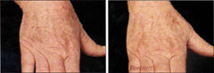 Plasma skin regeneration hands before and after photo