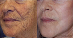 Plasma skin regeneration mouth before and after photo