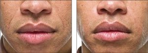 Radiesse mouth before and after photo