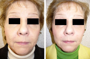 Restylane face before and after photo