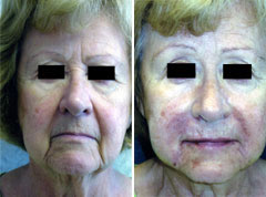 Restylane face before and after photo