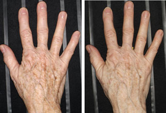 Thermage hands before and after photo
