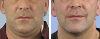 Thermage mouth before and after photo