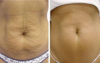 Thermage stomach before and after photo